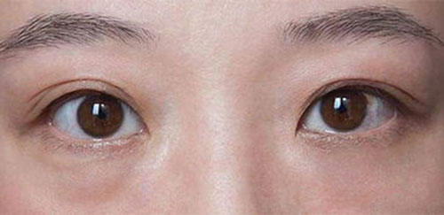 ����Ƥ������ô���� ��Ƥ��Ҫע��ʲô